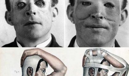 SHOCKING: Walter Yeo, the first person to receive plastic surgery, before (left) and after (right) skin flap surgery performed by Sir Harold Delf Gillies in 1917